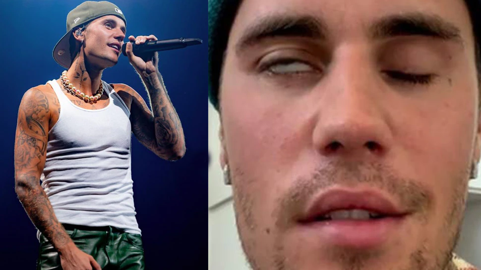 What is Ramsay Hunt Syndrome, the rare facial disorder that Justin Bieber suffers from?